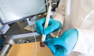 Bút chẩn đoán ung thư trong 10 giây