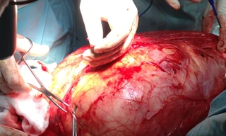 Bóc khối u gần 13kg từ chân bệnh nhân