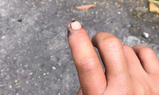 Bị rắn cắn, người đàn ông mang cả đầu rắn đến bệnh viện trong đêm