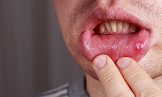 Bác sĩ cảnh báo những bệnh có thể lây khi quan hệ tình dục bằng miệng