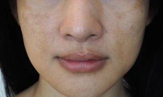 Nám da, những điều có thể bạn chưa biết 