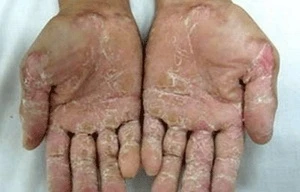 Quảng Ngãi cấp gạo, thuốc cho người bị bệnh viêm da