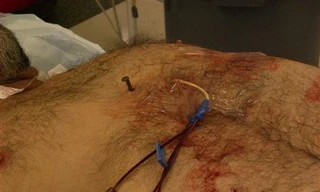 Chiếc đinh dài 10 cm đâm trúng tâm thất phải của anh Dennis Hennis