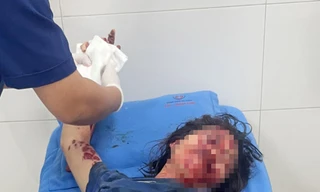 Điện thoại phát nổ khi đang sạc pin, một phụ nữ bị dập nát bàn tay