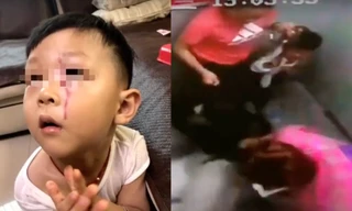 Cháu bé với vết thương trên mặt.