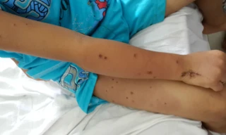 Các vết đốt của ong. 