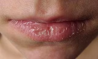 Môi của bệnh nhân bị kích ứng cho sử dụng son kém chất lượng. Ảnh: TH.