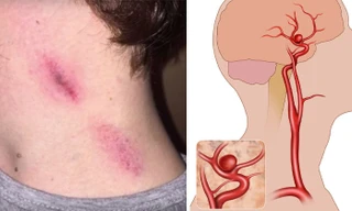 Động mạch cảnh là nơi rất nhạy cảm ở cổ