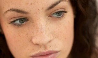 Tàn nhang là vết sạm nhỏ ngoài da. Hình minh họa.