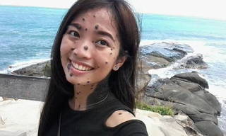 Từ khi sinh ra, Evita Delmundo đã có rất nhiều nốt ruồi trên khắp cơ thể.