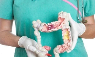 Viêm đại tràng có nhiều ổ viêm loét