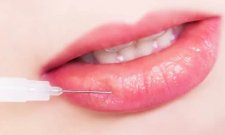 Sự thật tiêm filler môi làm đẹp ít ai biết