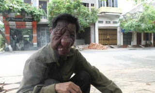 Ông Đỗ Văn Luyện và khối u quái ác trên mặt.