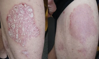 Hình ảnh trước và sau 8 tuần sử dụng sản phẩm thảo dược Dr Michaels Soratinex cho bệnh vảy nến.