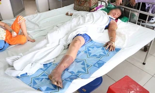 Chị M. bị bỏng 60% cơ thể đang được điều trị tại bệnh viện.
