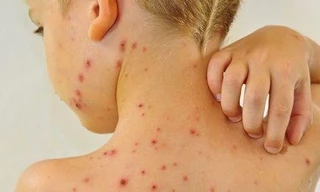 Các bệnh ngoài da do virus và giải pháp hay từ sản phẩm cốm Subạc