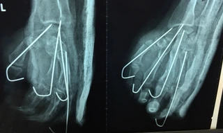 Ảnh chụp X-quang sau mổ của bệnh nhân. Ảnh bệnh viện cung cấp.