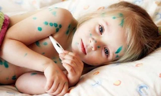 Các bậc cha mẹ không nên sử dụng các bài thuốc truyền miệng để điều trị thủy đậu cho trẻ. Ảnh: TL