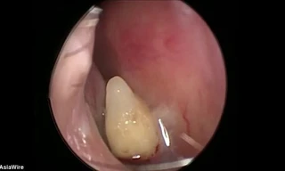 Chiếc răng mọc trong mũi bà Xia. Ảnh: Asiawire.