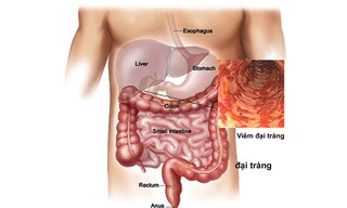 5 dấu hiệu giúp tự nhận biết sớm ung thư đại trực tràng