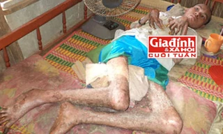 Anh Sang với căn bệnh lạ khiến cơ thể “hóa rắn” khủng khiếp. Ảnh TG