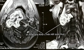 Hình ảnh khối u trên MRI.