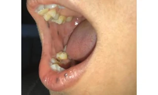 Nổi đốm sậm màu trên mặt, một phụ nữ Bến Tre mắc bệnh cực hiếm 