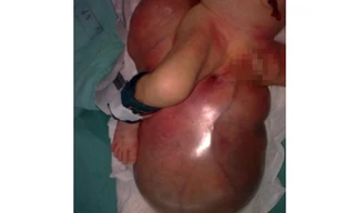 U quái khổng lồ vùng cùng cụt ở trẻ sơ sinh 5 ngày tuổi