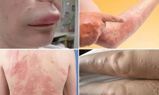 Xử lý các tình trạng da bị ngứa, cước, nẻ, nổi mề đay ngày lạnh