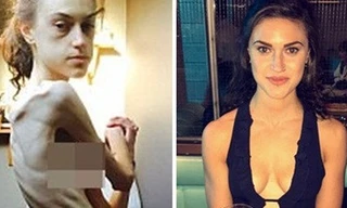 Emelle đã kịp nhận ra tình trạng gầy trơ xương và có biện pháp phục hồi. Ảnh: Daily Mail.