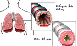 8 món cháo ngon chữa viêm khí quản, ho lâu ngày
