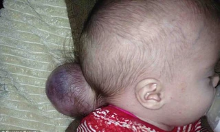 Bé Faith Martin với phần não nằm ngoài hộp sọ. Ảnh: Daily Mail