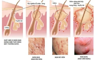 Cơ chế của mụn trứng cá.