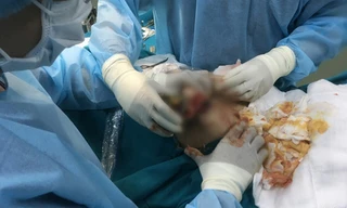 Từ vùng ngực của chị H lấy ra hàng lít chất lỏng màu vàng nhạt