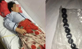 Một học sinh lớp 5 Trường Tiểu học An Bình B nuốt 9 viên bi sắt, phải nhập viện cấp cứu.