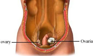 Minh họa so sánh buồng trứng bị ung thư (phải) và buồng trứng lànhẢnh: uvahealth.com