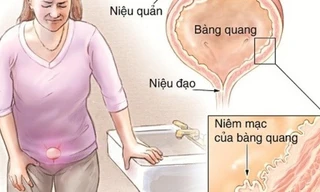 12 bài thuốc hỗ trợ điều trị viêm bàng quang cực hiệu quả