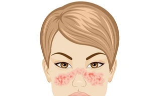 Vết phát ban hình con bướm cảnh báo nguy cơ mắc bệnh lupus. Ảnh: Pinterest.