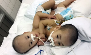 Hai Bé Long-Phụng khi chưa được tách rời.