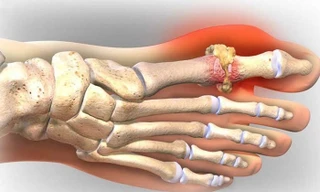 Những đồ ăn làm giảm cơn đau của người bệnh gút