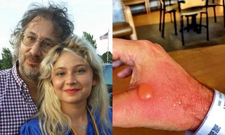 Bỏng độ 2 vì vắt nước cốt chanh dưới nắng