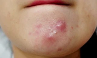 Mụn trứng cá dạng nang rất khó điều trị