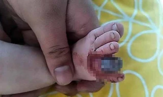 Ngón chân chuyển sang màu đen do bị sợi tóc quấn chặt. Ảnh: Daily Mail.