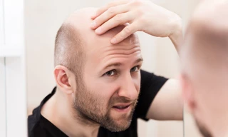 Rụng tóc từng mảng nếu không kịp “cứu” tế bào mầm tóc sẽ dẫn đến hói đầu