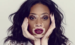 Hội chứng khiến người bệnh sở hữu vẻ ngoài kỳ dị có 1 không 2