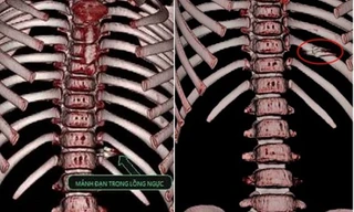 Hình ảnh chụp 3D lồng ngực cho thấy mảnh đạn găm trong ngực bé gái. Ảnh: Hà Trang