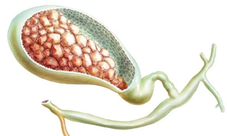 4 triệu chứng phố biến của bệnh sỏi mật