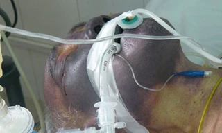 Bệnh nhân bị nhiễm liên cầu khuẩn lợn tại khoa cấp cứu, BV bệnh Nhiệt đới TW.