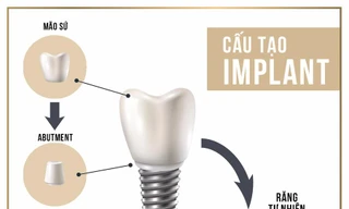 Trồng răng Implant – giải pháp toàn năng khi mất răng