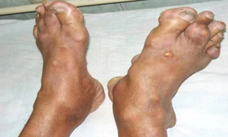 Chân bệnh nhân mắc bệnh gout. Ảnh: BSCC.